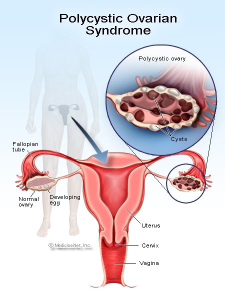 Sindromul ovarian policistic